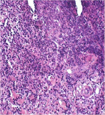 foot rot bacteria under microscope showing dark purple, pink and white splotches